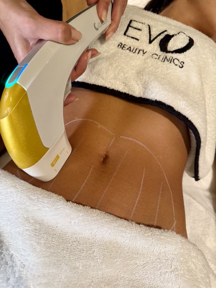 Cabezal EVO Beauty Clinics aplicado sobre el abdomen marcado para el tratamiento